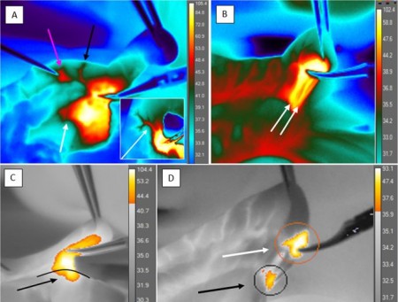 Тепловизоры в хирургии